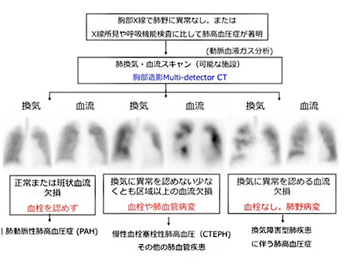 Cteph（慢性血栓塞栓性肺高血圧症）の診断 