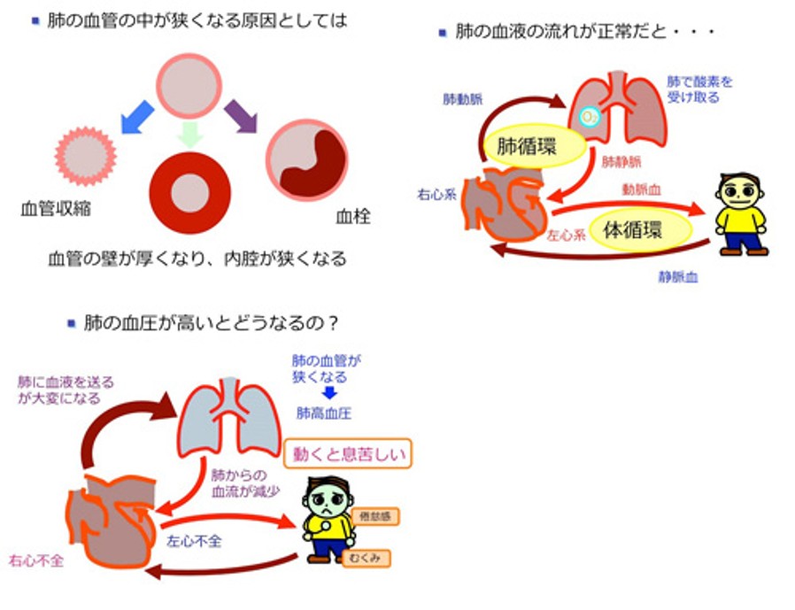 図は肺動脈性肺高血圧症が発症する機序を示す