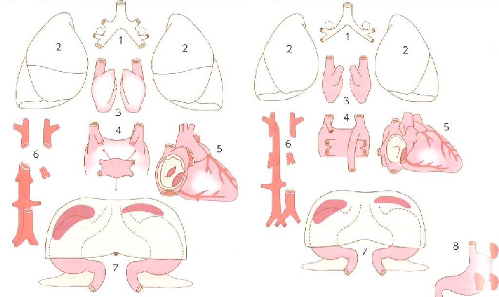 無脾症候群（指定難病189） – 難病情報センター