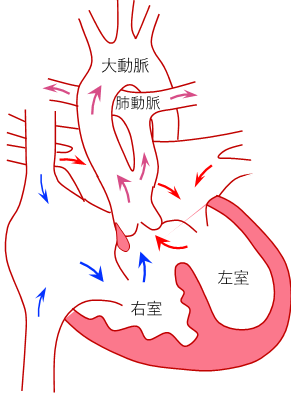 病名：総動脈幹遺残症とは？