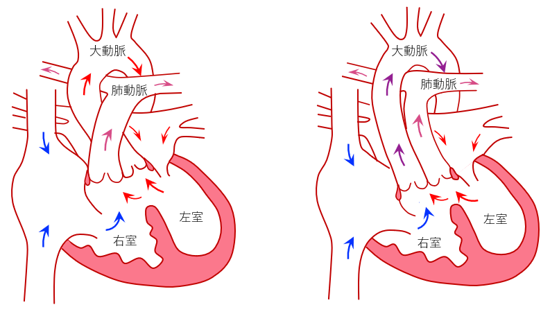 病名：両大血管右室起始症とは？