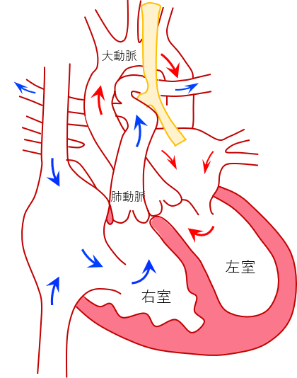 図は左肺動脈右肺動脈起始症（左肺動脈が気管の右側から分岐し、気管を取り巻くために、気管が圧迫されている）