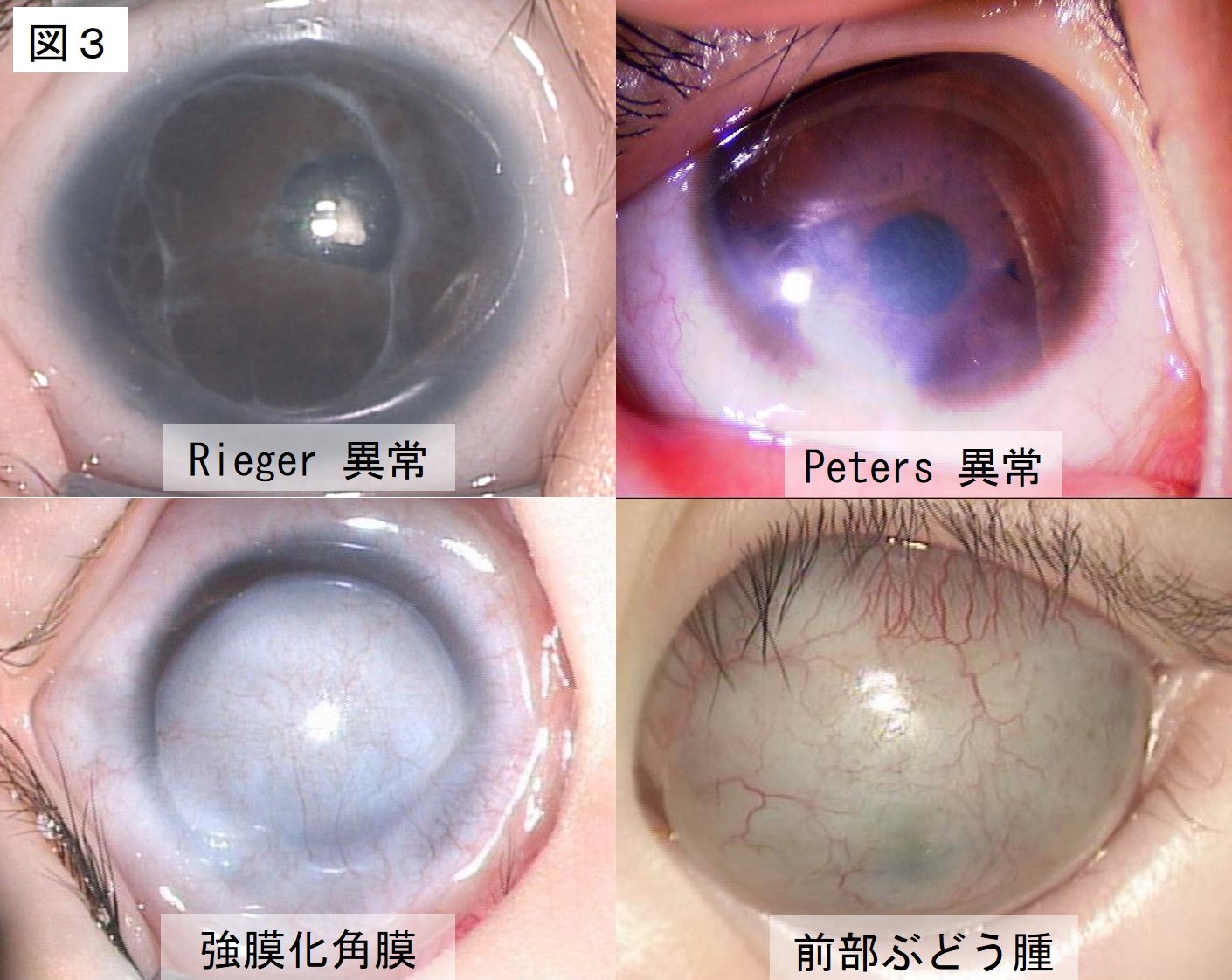 図３は代表的な異常の代表例4つの写真（Rieger異常、Peters異常、強膜化角膜、前眼部ぶどう腫