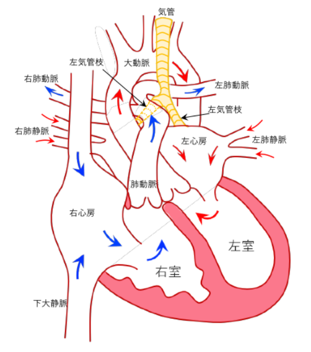 図は左肺動脈右肺動脈起始症（左肺動脈が気管の右側から分岐し、気管を取り巻くために、気管が圧迫されている）