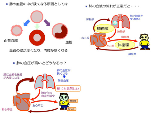 肺動脈性肺高血圧症 指定難病８６ 難病情報センター