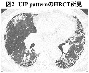 図２　肺組織の比較