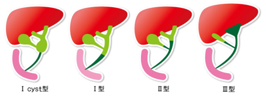 胆管の閉塞部位によって4つに分類される胆汁性肝硬変症の図（濃緑色部分は閉塞部位）