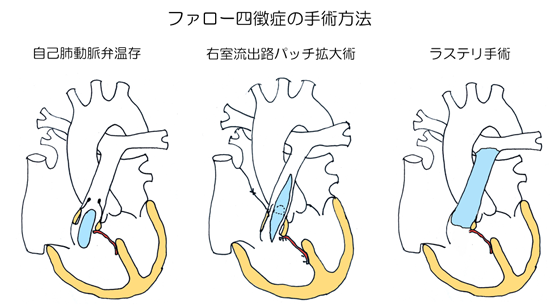 ファロー四徴症 指定難病２１５ 難病情報センター