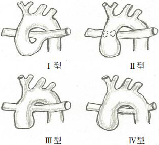 病名:総動脈幹遺残症とは?