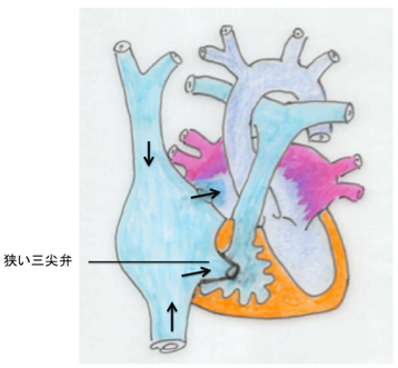 先天性三尖弁狭窄症 指定難病３１１ 難病情報センター