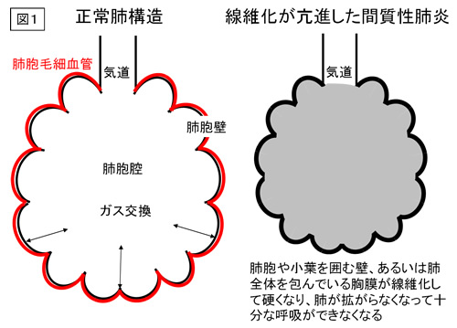 間 質 性 肺炎 急性 増悪