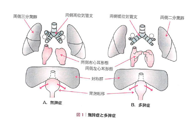 多脾症候群 指定難病１８８ 難病情報センター