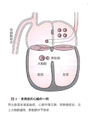 多脾症候群 指定難病１８８ 難病情報センター